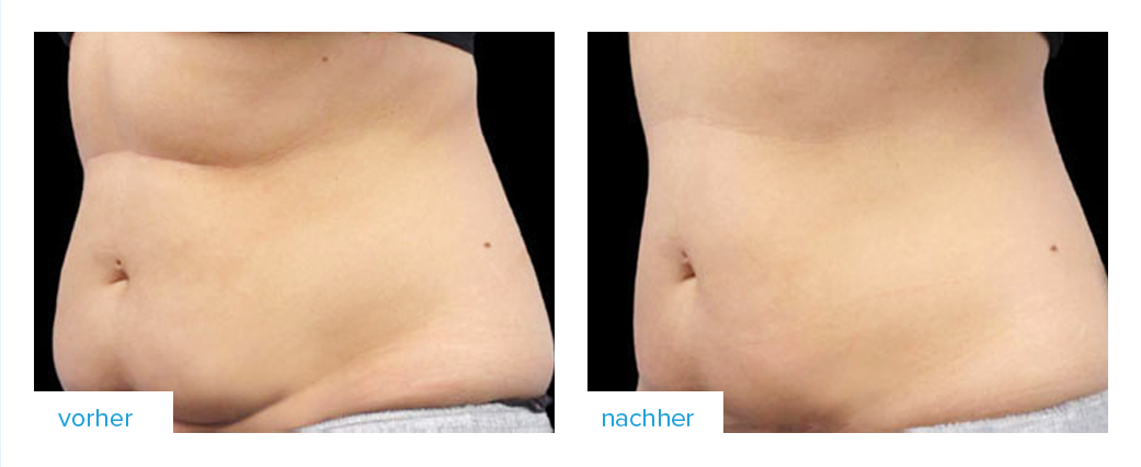 Erfahrung mit Fettabsaugung ohne Operation Coolsculpting by Dr